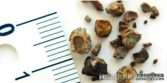 22岁女患者口述：我跟胆结石之间的故事