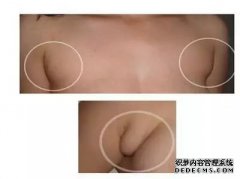 腋下长肉，警惕！可能大病在靠近！ 耳光