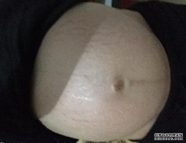 产后没有“妊娠纹”的女性，大多都与这3点有关，快来看有没有你