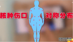 女子为瘦身埋下40根线，全身化脓险些丧