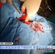 十一岁女孩经过家楼下被砸伤，头部缝六
