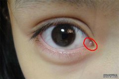 早上起床突然眼屎增多，是怎么回事？
