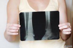 为什么女性更容易受到骨质疏松的困扰？