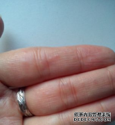 手上起小水泡是怎么回事？家长们一定要