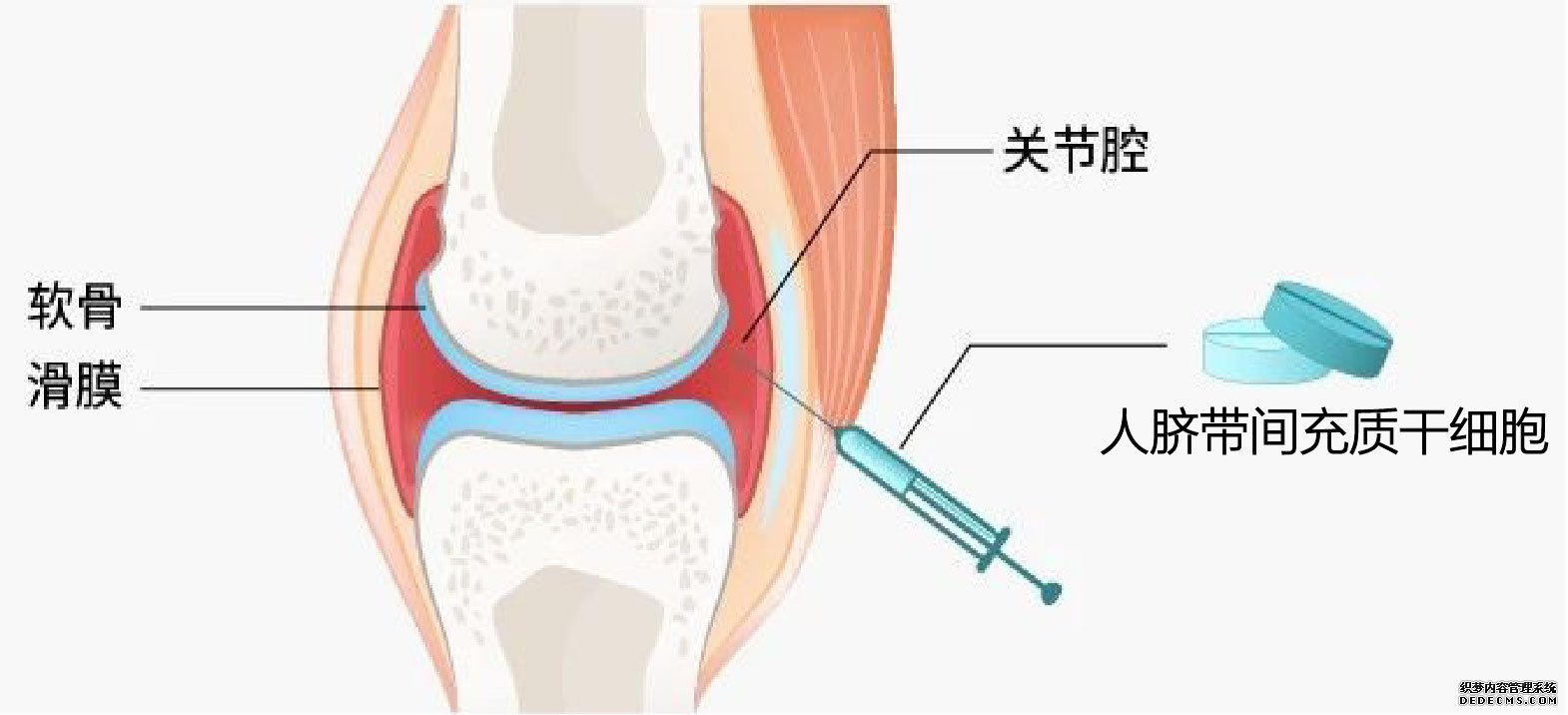 人脐带间充质干细胞可以安全有效的治疗膝关节炎吗？