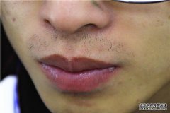 女性长小胡子是怎么回事？