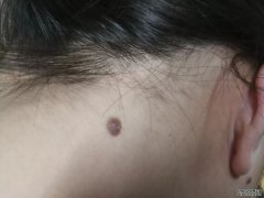 长在8个部位的黑痣，或与癌症“息息相关
