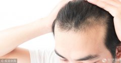 保护发际线别做这几件事